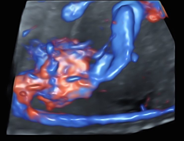 How To Do Aprile 2023: vascolarizzazione addominale fetale