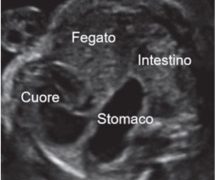 Guida al Counselling di Aprile 2023: ernia diaframmatica