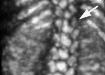 How To Do Maggio 2023: uso del 3D nella valutazione della colonna vertebrale