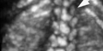 How To Do Maggio 2023: uso del 3D nella valutazione della colonna vertebrale