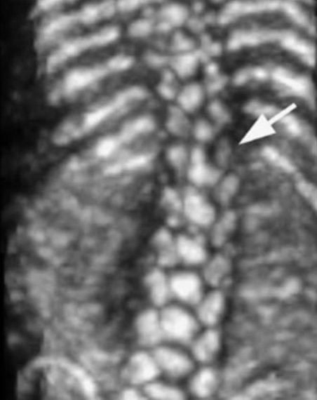 How To Do Maggio 2023: uso del 3D nella valutazione della colonna vertebrale