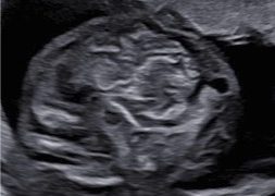 Guida al Counselling di Maggio 2023: iperecogenicità intestinale