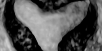 How To Do Giugno 2023: classificazione ecografica dell’utero setto