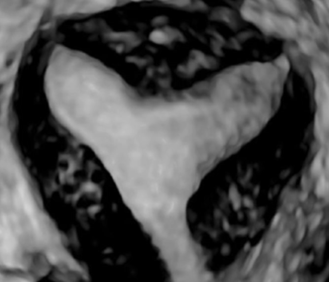 How To Do Giugno 2023: classificazione ecografica dell’utero setto