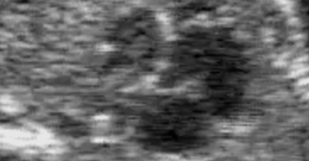 Guida al Counselling di Agosto 2023: cuore sinistro ipoplasico