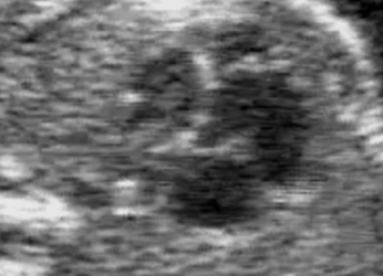 Guida al Counselling di Agosto 2023: cuore sinistro ipoplasico