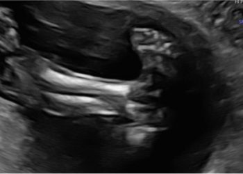 Guida al Counselling di Settembre 2023: piede torto congenito