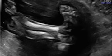 Guida al Counselling di Settembre 2023: piede torto congenito