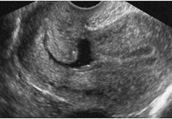 Guida al Counselling di Ottobre 2023: istmocele