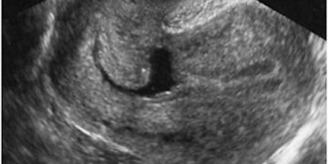 Guida al Counselling di Ottobre 2023: istmocele