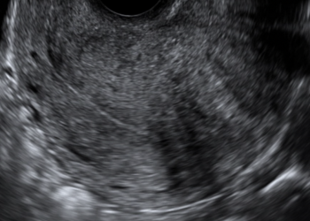 How To Do OTTOBRE 2023: studio ecografico dell’adenomiosi.