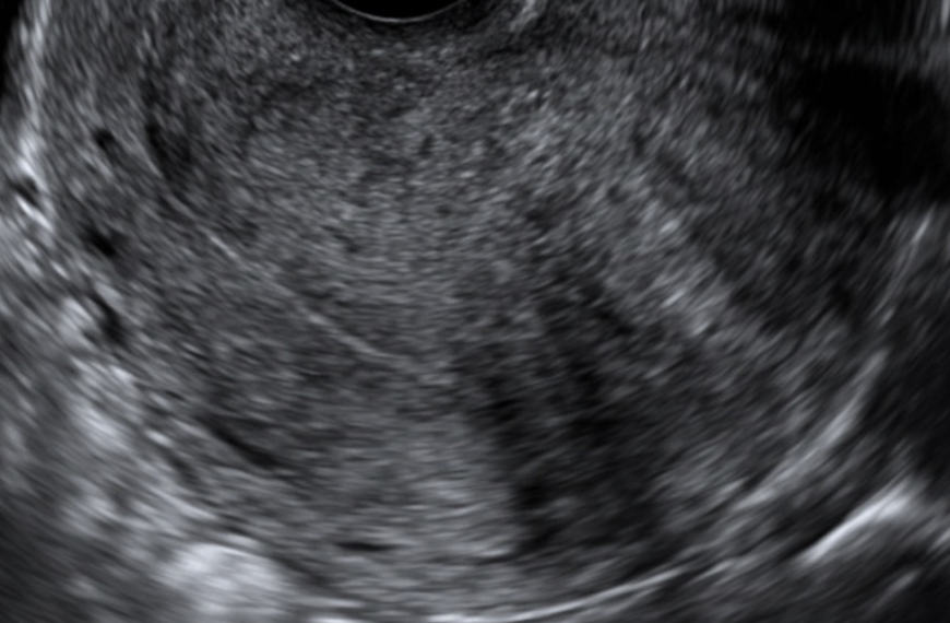 How To Do OTTOBRE 2023: studio ecografico dell’adenomiosi.