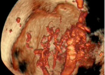 How To Do Novembre 2023: placenta accreta spectrum (PAS)