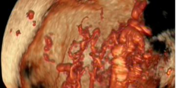 How To Do Novembre 2023: placenta accreta spectrum (PAS)