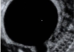 Guida al Counselling di Dicembre 2023: Megavescica fetale