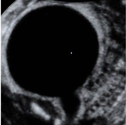 Guida al Counselling di Dicembre 2023: Megavescica fetale