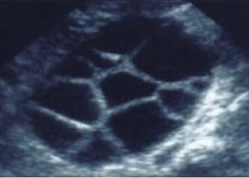 Guida al Counselling di Gennaio 2024: Iperstimolazione ovarica