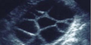 Guida al Counselling di Gennaio 2024: Iperstimolazione ovarica