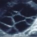 Guida al Counselling di Gennaio 2024: Iperstimolazione ovarica