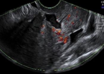 How To Do Febbraio 2024: Istmocele