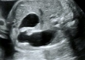 Guida al Counselling di Febbraio 2024: atresia duodenale