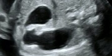 Guida al Counselling di Febbraio 2024: atresia duodenale