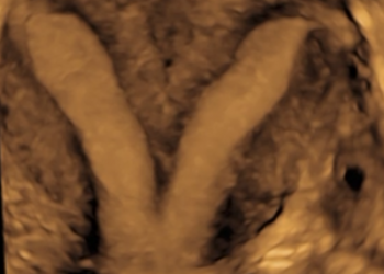 How To Do Marzo 2024: malformazioni uterine