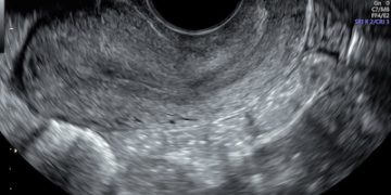 Guida al Counselling di Maggio 2024: ispessimento endometriale in menopausa