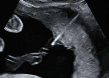 How To Do Giugno 2024: diagnosi e gestione delle anemie fetali