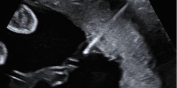 How To Do Giugno 2024: diagnosi e gestione delle anemie fetali