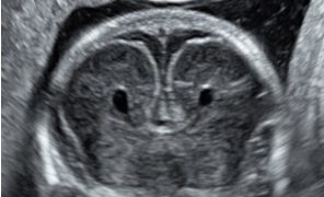 Guida al Counselling di Agosto 2024: agenesia del corpo calloso