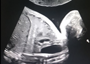 Guida al Counselling di Settembre 2024: atresia esofagea