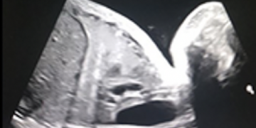 Guida al Counselling di Settembre 2024: atresia esofagea