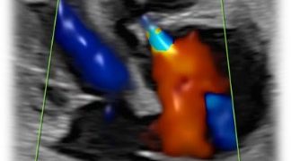 Guida al Counselling di Novembre 2024: anomalia di Ebstein