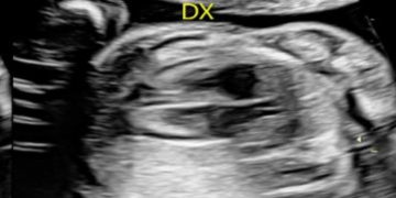 Guida al Counselling di Dicembre 2024: sequestro polmonare