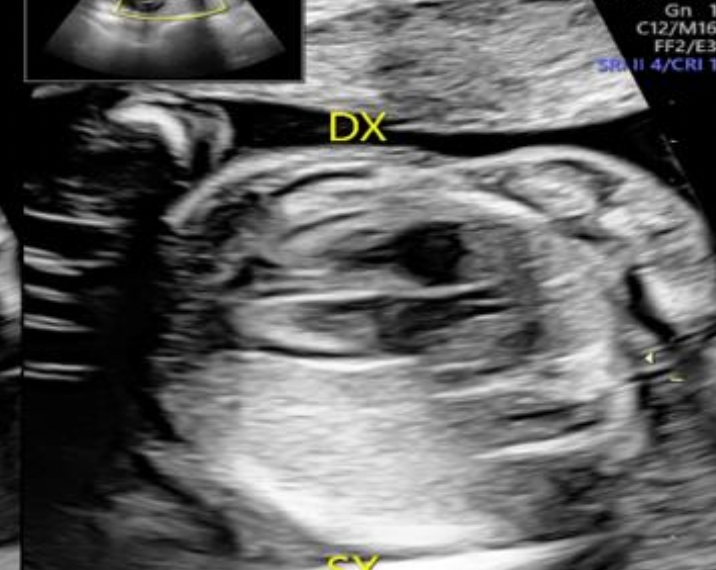 Guida al Counselling di Dicembre 2024: sequestro polmonare