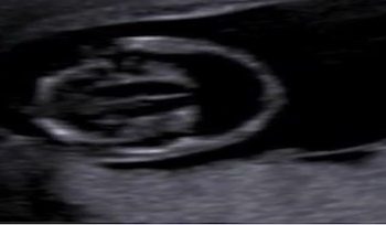 Guida al Counselling di Gennaio 2025: oloprosencefalia