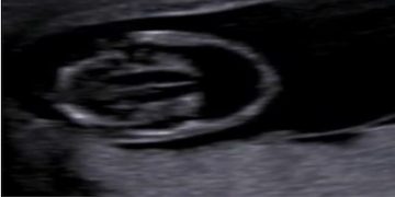 Guida al Counselling di Gennaio 2025: oloprosencefalia