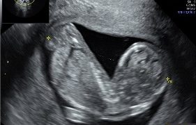 Casi del Mese di Febbraio 2025