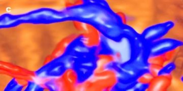 Guida al Counselling di Febbraio 2025: coartazione aortica