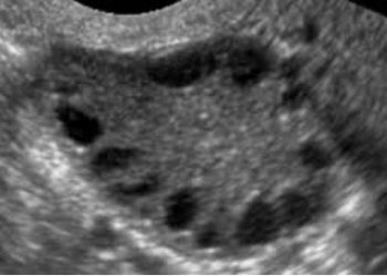 Guida al Counselling di Marzo 2025: PCOS