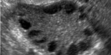 Guida al Counselling di Marzo 2025: PCOS