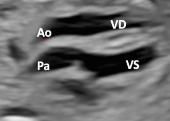 Guida al Counselling di Aprile 2025: Trasposizione completa delle Grandi Arterie