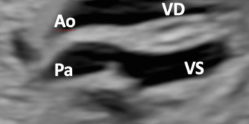 Guida al Counselling di Aprile 2025: Trasposizione completa delle Grandi Arterie