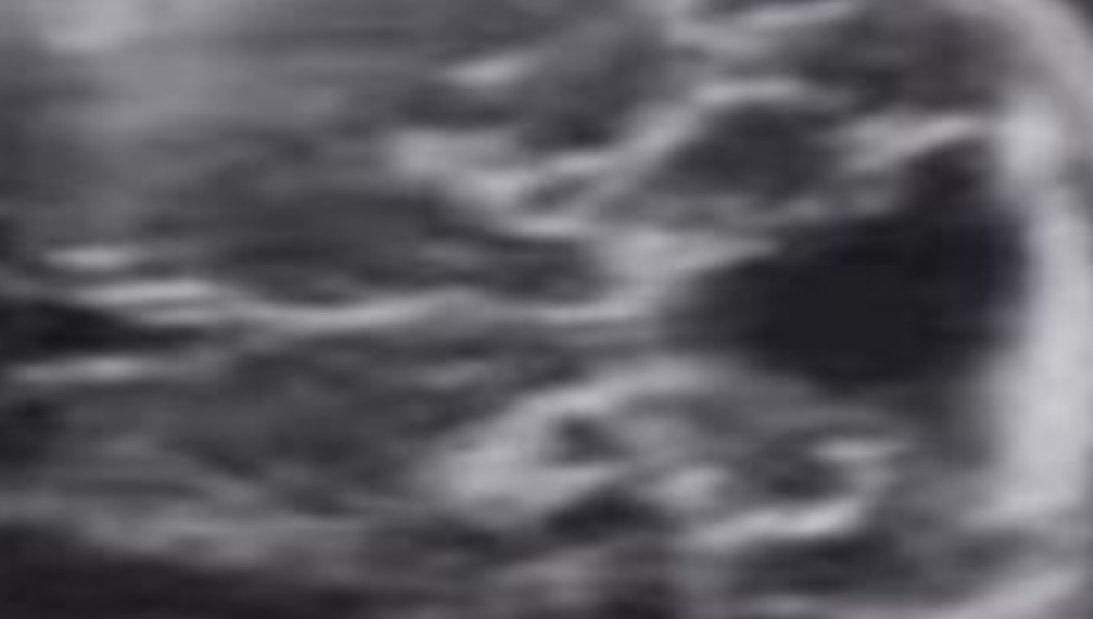 Guida al Counselling di Maggio 2025: patologie cistiche della fossa cranica posteriore