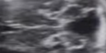 Guida al Counselling di Maggio 2025: patologie cistiche della fossa cranica posteriore