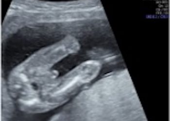 Guida al Counselling di Luglio 2025: genitali ambigui