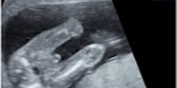 Guida al Counselling di Luglio 2025: genitali ambigui