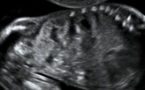 Guida al Counselling di Agosto 2025: rene a ferro di cavallo