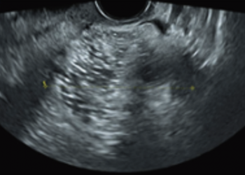 Guida al Counselling di Settembre 2025: teratoma cistico maturo
